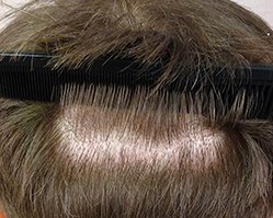 Slider image (2) AEK Hair Institute